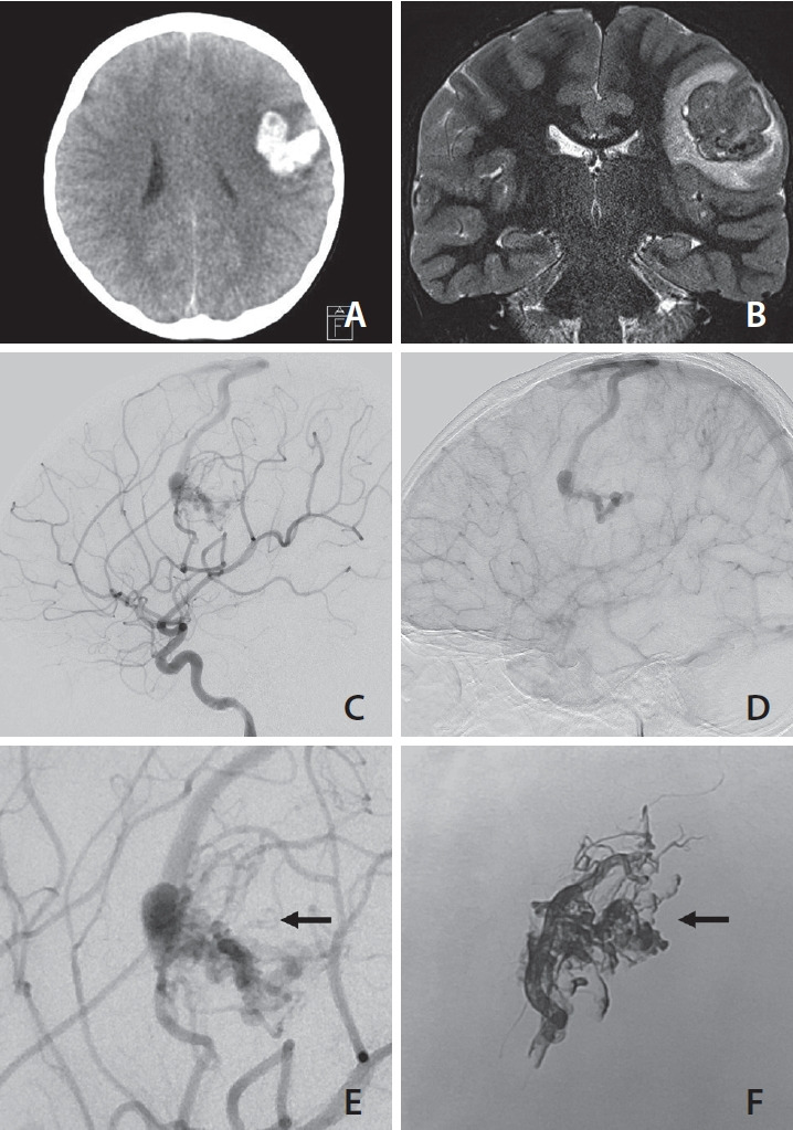 Obscured Segments of Ruptured Brain Arteriovenous Malformations: Insights from Their Visualization during Emergency Transarterial Embolization.