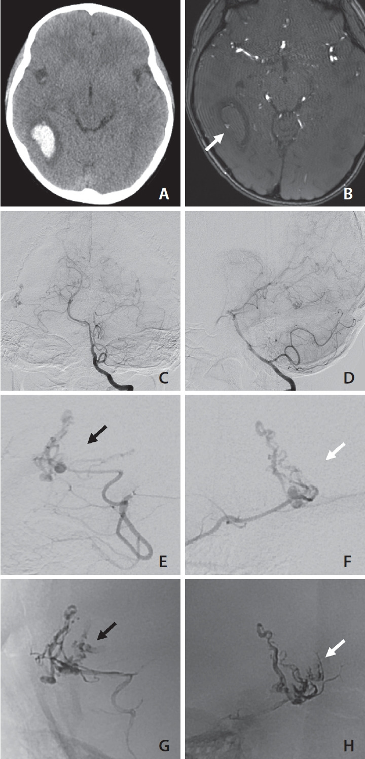 Obscured Segments of Ruptured Brain Arteriovenous Malformations: Insights from Their Visualization during Emergency Transarterial Embolization.