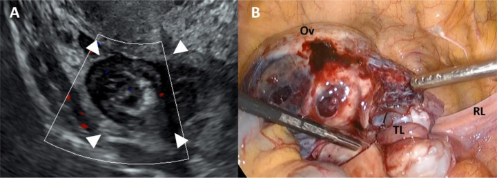 Step-by-step instructions for detecting whirlpool sign in adnexal torsion.