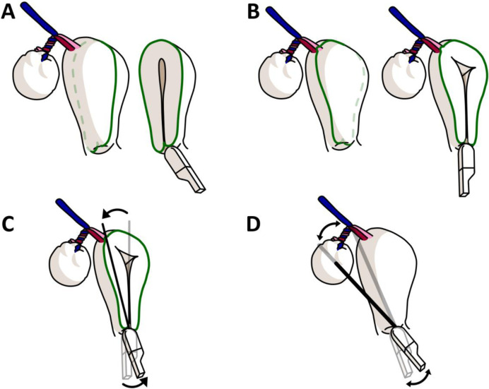 Step-by-step instructions for detecting whirlpool sign in adnexal torsion.