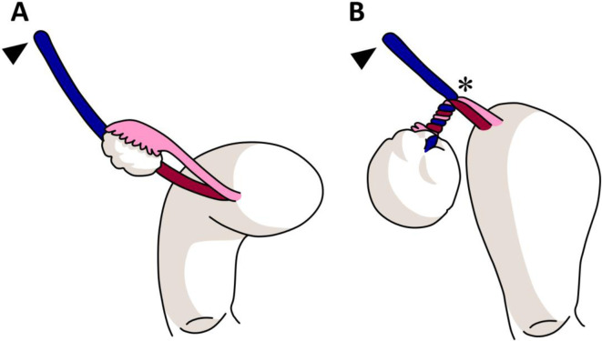 Step-by-step instructions for detecting whirlpool sign in adnexal torsion.