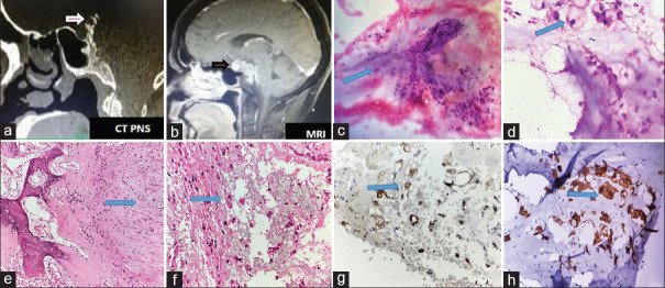 Cytodiagnosis of Clival Chordoma.