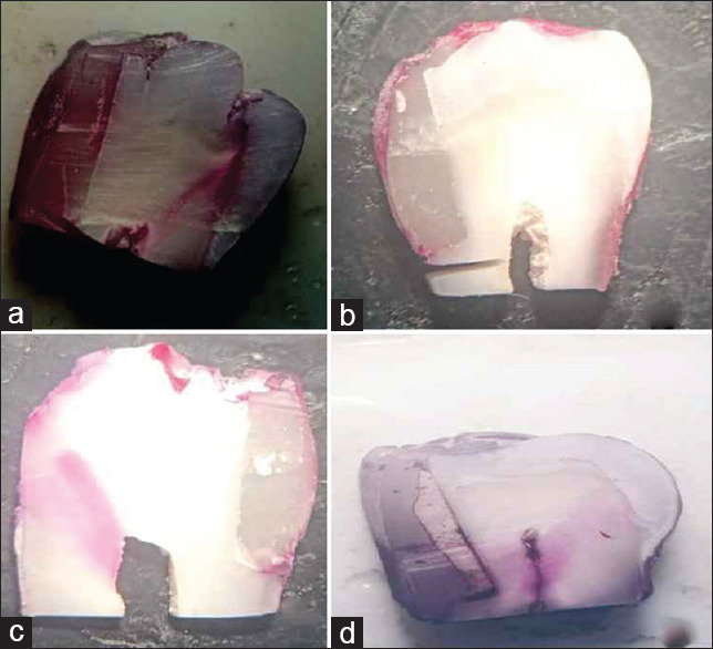 The efficacy of lining materials in the reduction of microleakage in class II composite resin restoration using the sandwich technique: A stereomicroscopic study.