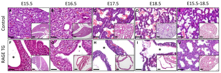 Decreased Expression of Pulmonary Homeobox NKX2.1 and Surfactant Protein C in Developing Lungs That Over-Express Receptors for Advanced Glycation End-Products (RAGE).