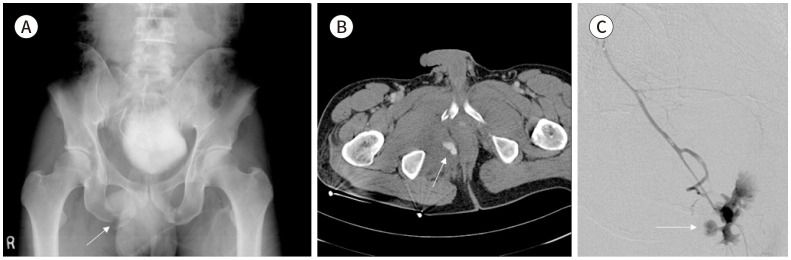 [Interventional Management for Pelvic Trauma].