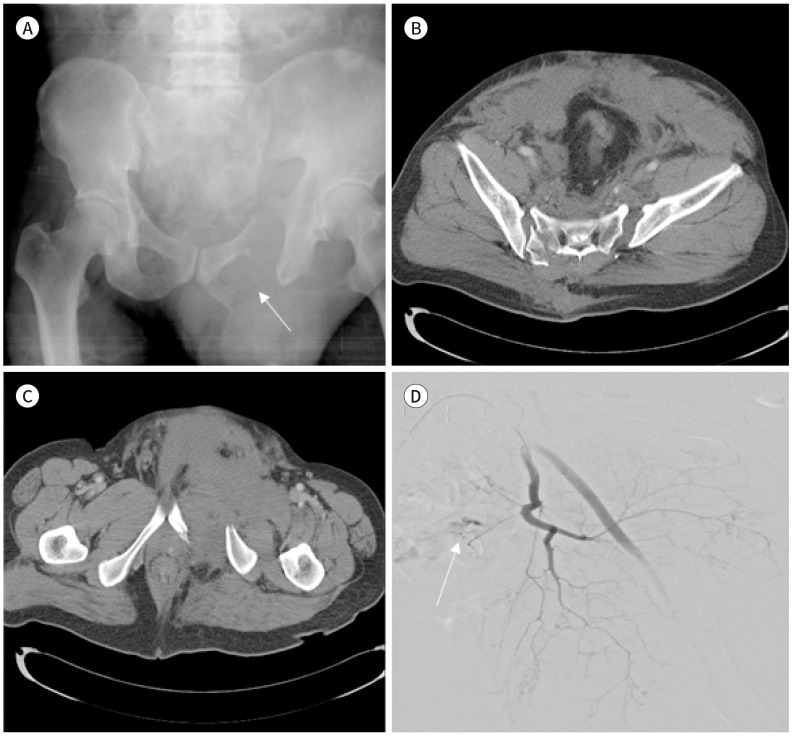 [Interventional Management for Pelvic Trauma].