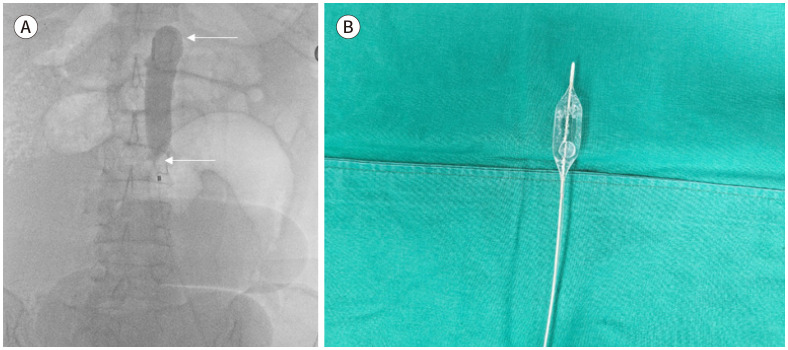 [Interventional Management for Pelvic Trauma].