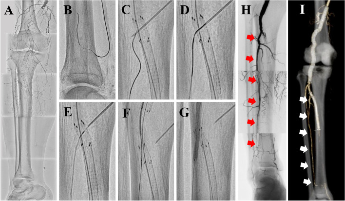 The ViaHole technique: a novel approach for recanalizing major side branch occluded by Viabahn stent-graft.