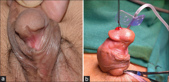 Grafted tubularised incised plate: A right option in the management of failed mid-penile and distal hypospadias.