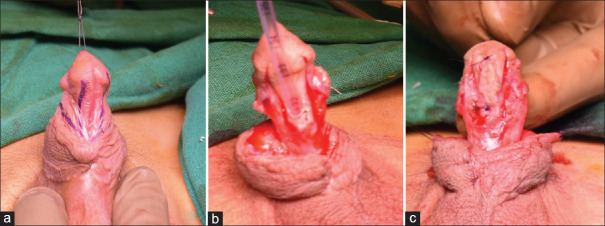 Grafted tubularised incised plate: A right option in the management of failed mid-penile and distal hypospadias.