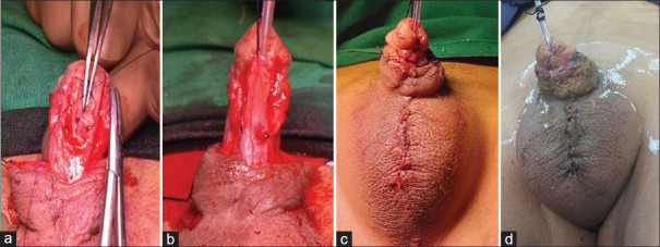 Grafted tubularised incised plate: A right option in the management of failed mid-penile and distal hypospadias.