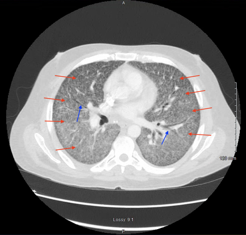 Disseminated Histoplasmosis in a Patient With Acquired Immunodeficiency Syndrome in a Non-Endemic Region (California).