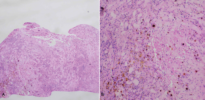 Infarctive Apoplexy of Previously Healthy Pituitary Glands: A Small Case Series and Literature Review.