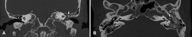 A Case of Unilateral Otologic Symptoms as Initial Manifestations of Granulomatosis With Polyangiitis.