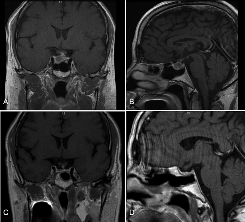 Infarctive Apoplexy of Previously Healthy Pituitary Glands: A Small Case Series and Literature Review.