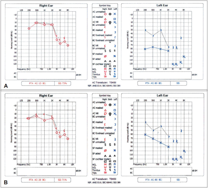 A Case of Unilateral Otologic Symptoms as Initial Manifestations of Granulomatosis With Polyangiitis.