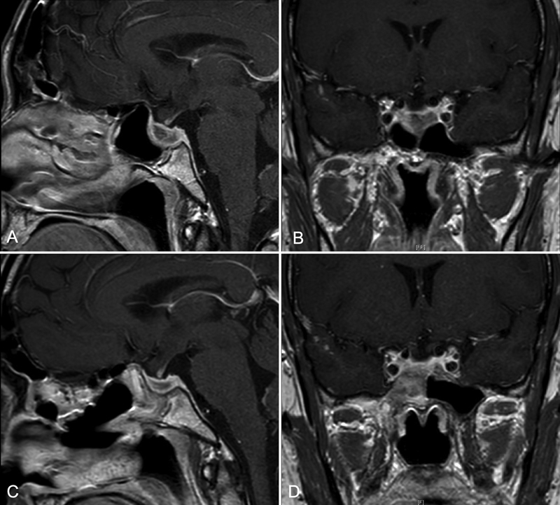 Infarctive Apoplexy of Previously Healthy Pituitary Glands: A Small Case Series and Literature Review.