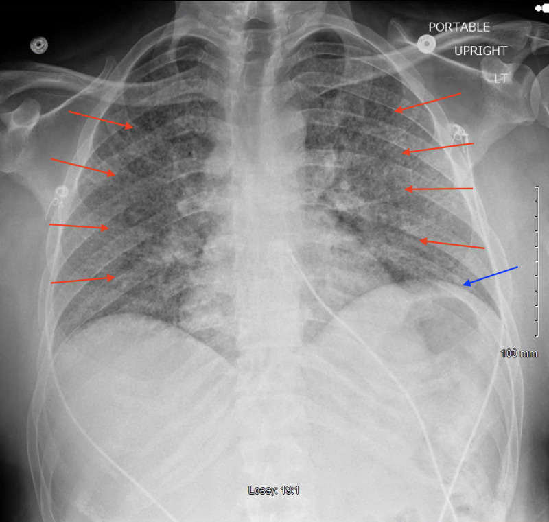 Disseminated Histoplasmosis in a Patient With Acquired Immunodeficiency Syndrome in a Non-Endemic Region (California).