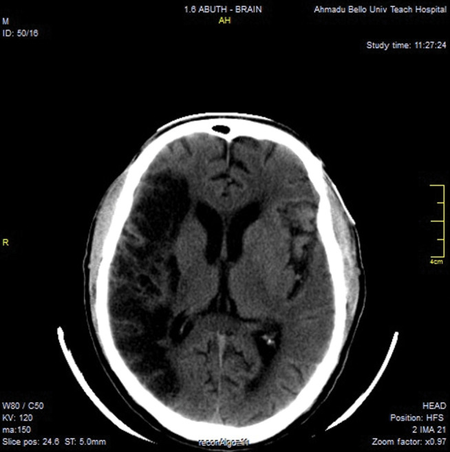 Evaluation of Pattern of Lesions Depicted on Brain Computed Tomography Scan of Patients Presenting with Stroke in Zaria, Nigeria.