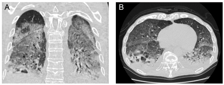 Intraparenchymal Lung Abscess Complicating a Primary COVID-19 Infection in a Patient with Waldenström's Macroglobulinemia: A Case Report.