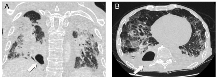 Intraparenchymal Lung Abscess Complicating a Primary COVID-19 Infection in a Patient with Waldenström's Macroglobulinemia: A Case Report.