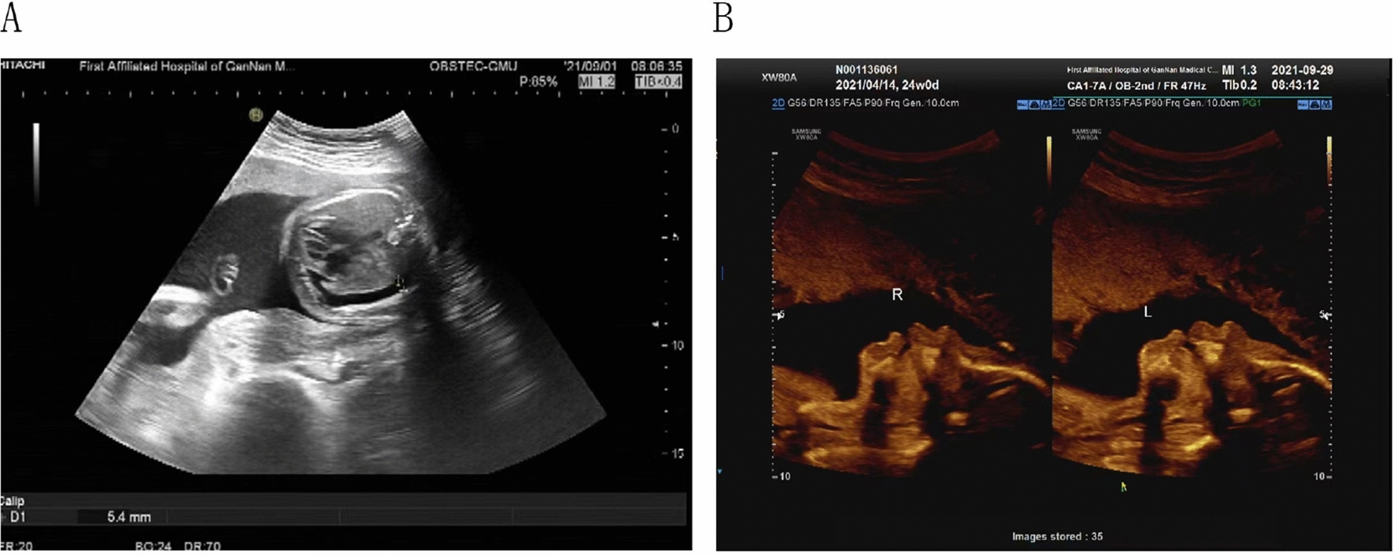 Two cases of placental trisomy 21 mosaicism causing false-negative NIPT results.