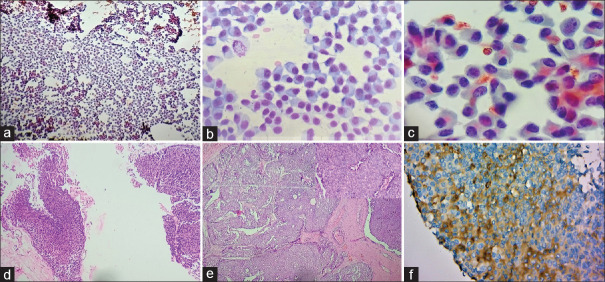 Plasmacytoid Cells in Aspiration Smears of the Breast: Every Time a New Surprise.