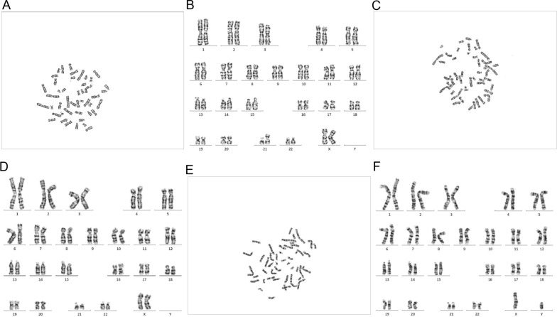 Two cases of placental trisomy 21 mosaicism causing false-negative NIPT results.