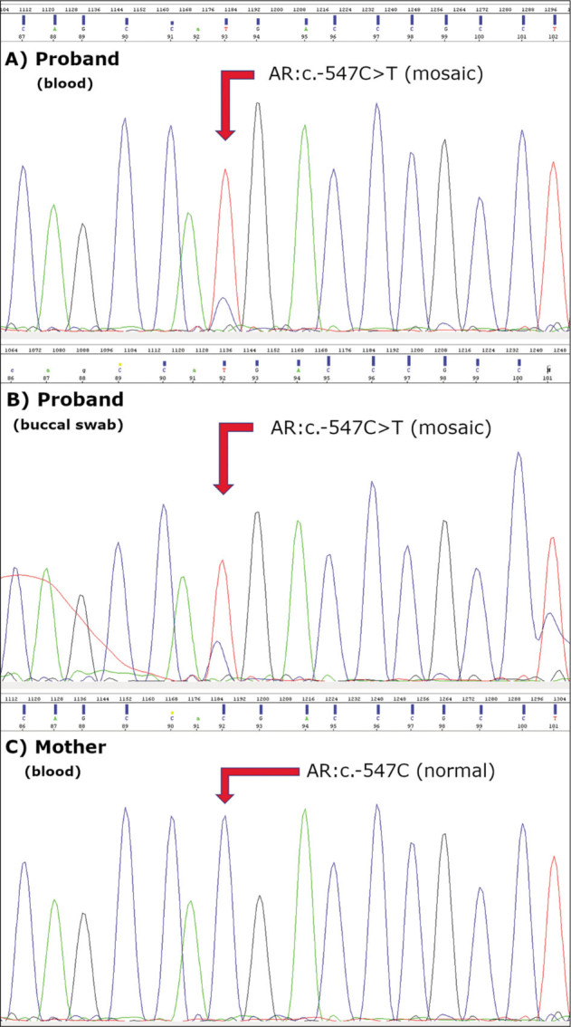 Androgen Insensitivity Syndrome DUE to Non-Coding Variation in the Androgen Receptor Gene: Review of the Literature and Case Report of a Patient with Mosaic c.-547C>T Variant.