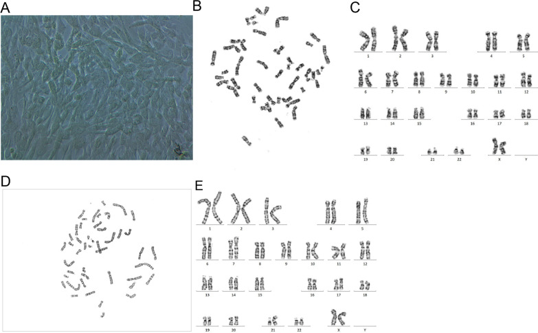 Two cases of placental trisomy 21 mosaicism causing false-negative NIPT results.