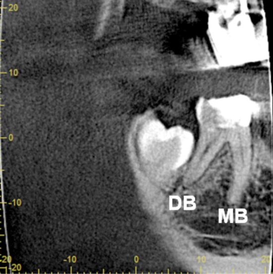 An atypical anatomy of permanent mandibular second molar with five roots.
