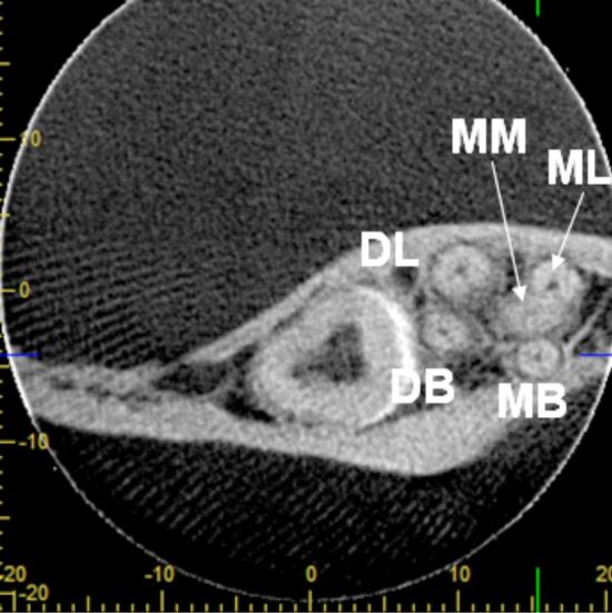 An atypical anatomy of permanent mandibular second molar with five roots.