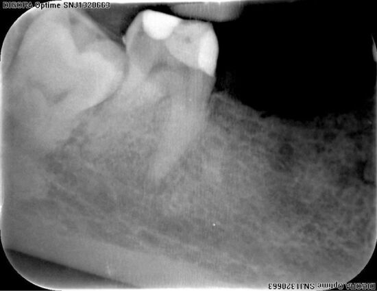 An atypical anatomy of permanent mandibular second molar with five roots.