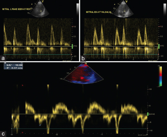 The Mitral L-wave: A Marker of Advanced Diastolic Dysfunction.