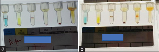Hemolysis in reverse grouping: Evaluation and implication of high titer isoagglutinin of two blood donors.