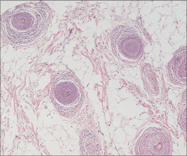 A puzzling Presentation of Alopecia Areata: Sudden-Onset Whitening of Hair and its Spontaneous Resolution.
