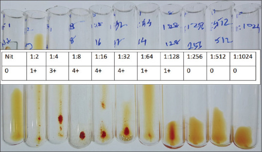Hemolysis in reverse grouping: Evaluation and implication of high titer isoagglutinin of two blood donors.