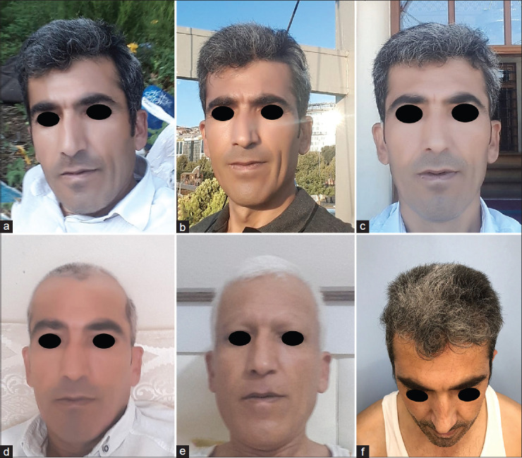A puzzling Presentation of Alopecia Areata: Sudden-Onset Whitening of Hair and its Spontaneous Resolution.