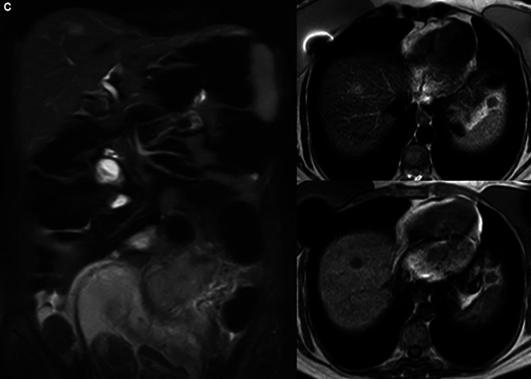 A Review of the Literature, the Detection and Treatment of Colorectal Cancer during Pregnancy: A Case Study!