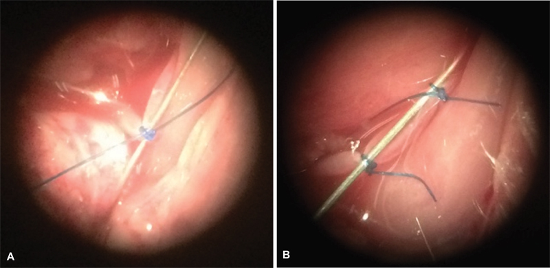Development of a Model for Plaque Induction in Rat Carotid Arteries.