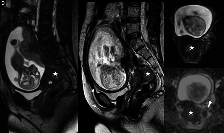 A Review of the Literature, the Detection and Treatment of Colorectal Cancer during Pregnancy: A Case Study!