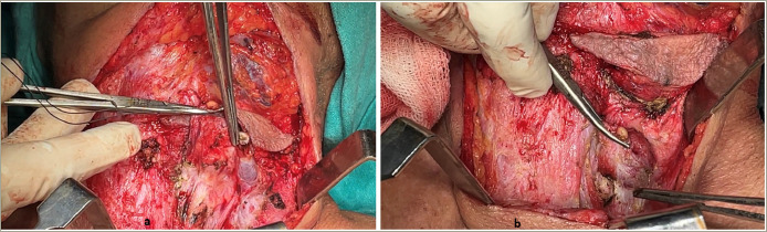 Parathyroid Carcinoma Presenting as Recurrent Primary Hyperparathyroidism and Neck Mass: A Case Report.
