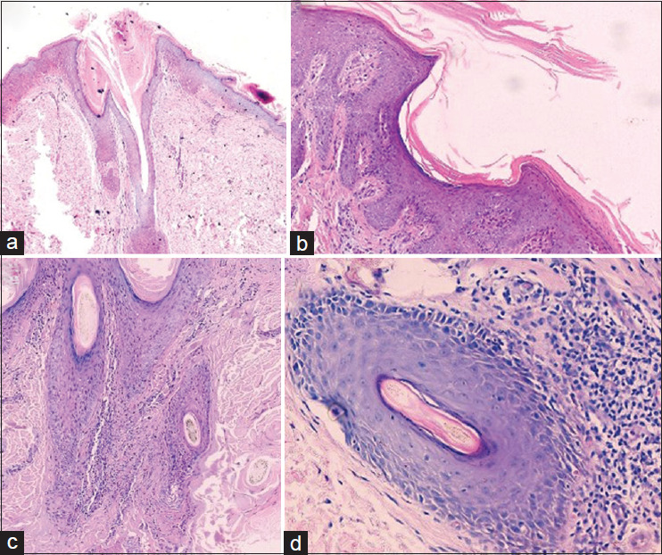 A Clinical, Dermoscopic, and Histopathological Study of Follicular Psoriasis.