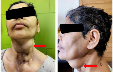 Parathyroid Carcinoma Presenting as Recurrent Primary Hyperparathyroidism and Neck Mass: A Case Report.