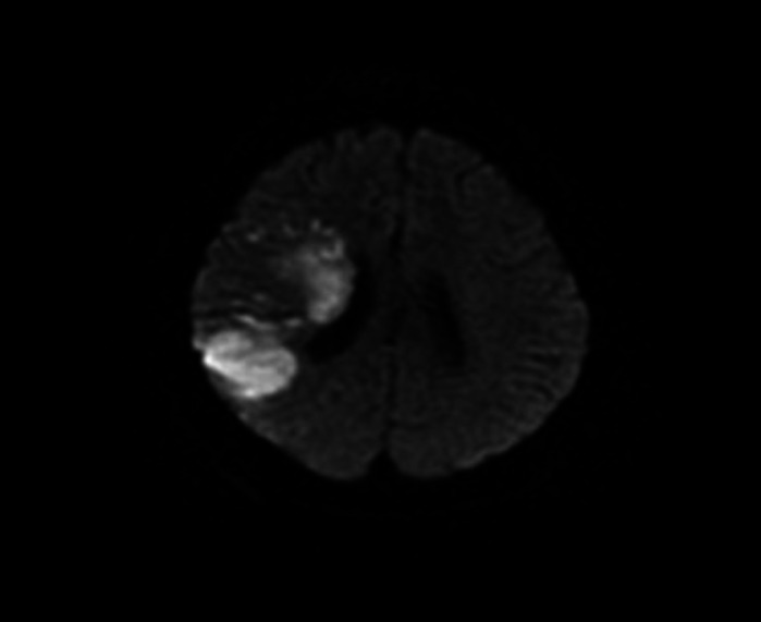 Double Embolism: A Very Rare Presentation of Concurrent Pulmonary Embolism and Embolic Stroke without Arterivenous Shunt.