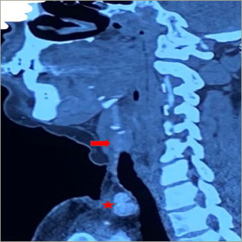 Parathyroid Carcinoma Presenting as Recurrent Primary Hyperparathyroidism and Neck Mass: A Case Report.