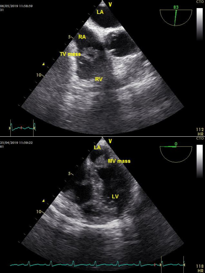 Double Embolism: A Very Rare Presentation of Concurrent Pulmonary Embolism and Embolic Stroke without Arterivenous Shunt.