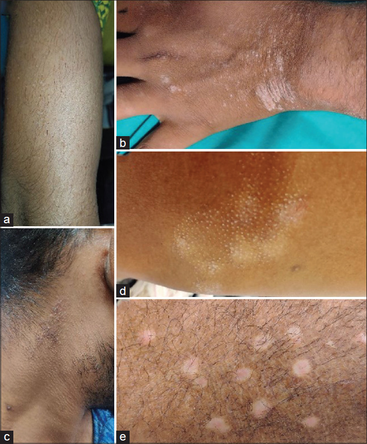 A Clinical, Dermoscopic, and Histopathological Study of Follicular Psoriasis.