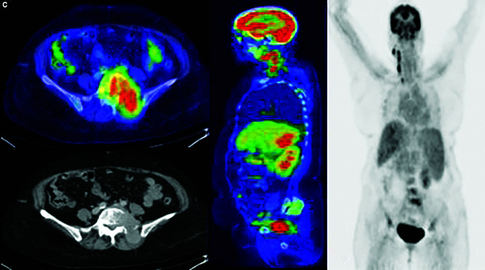 Detection of Primary Hepatocellular Carcinoma on <sup>18</sup>F-Fluorodeoxyglucose Positron Emission Tomography-computed Tomography.
