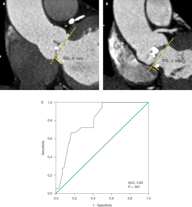 [Relationship between membranous septum length and need for pacemaker implantation after transcatheter aortic valve implantation].